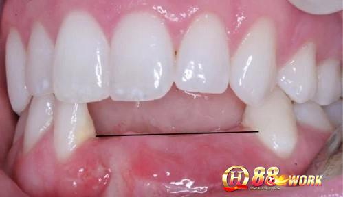 Mơ bị rụng răng hàm dưới báo hiệu rằng người thân trong gia đình gặp vấn đề sức khỏe