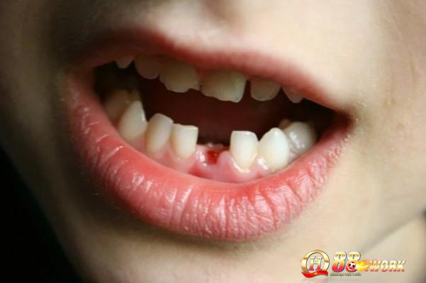 Nằm mơ thấy rụng răng chảy máu có biểu hiện như 1 nỗi tự ti