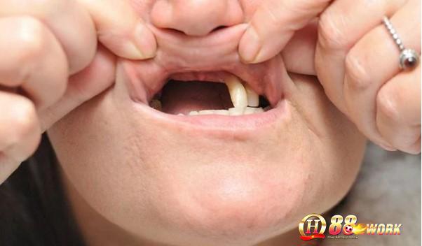Những giấc mơ về việc răng hàm trên bị rụng là biểu hiện về sự khó khăn 